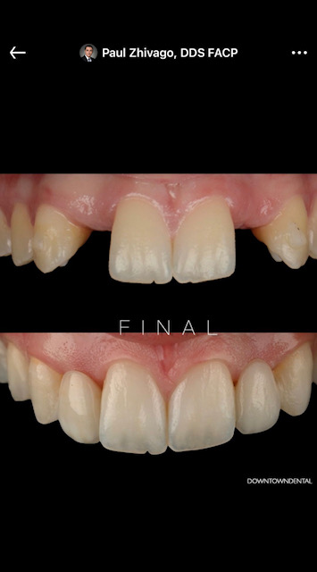 Aesthetic Veneer Case
